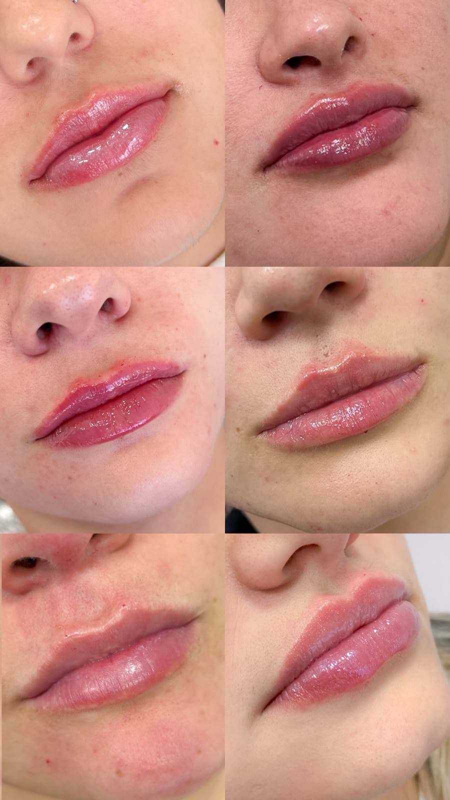 Antes e depois de preenchimento labial