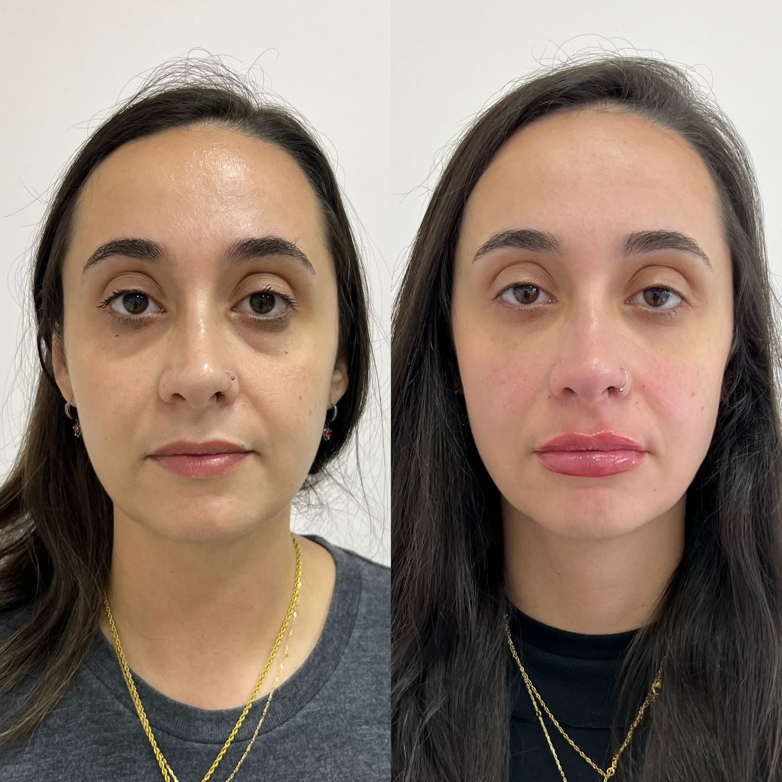 Antes e depois de preenchimento labial e olheiras