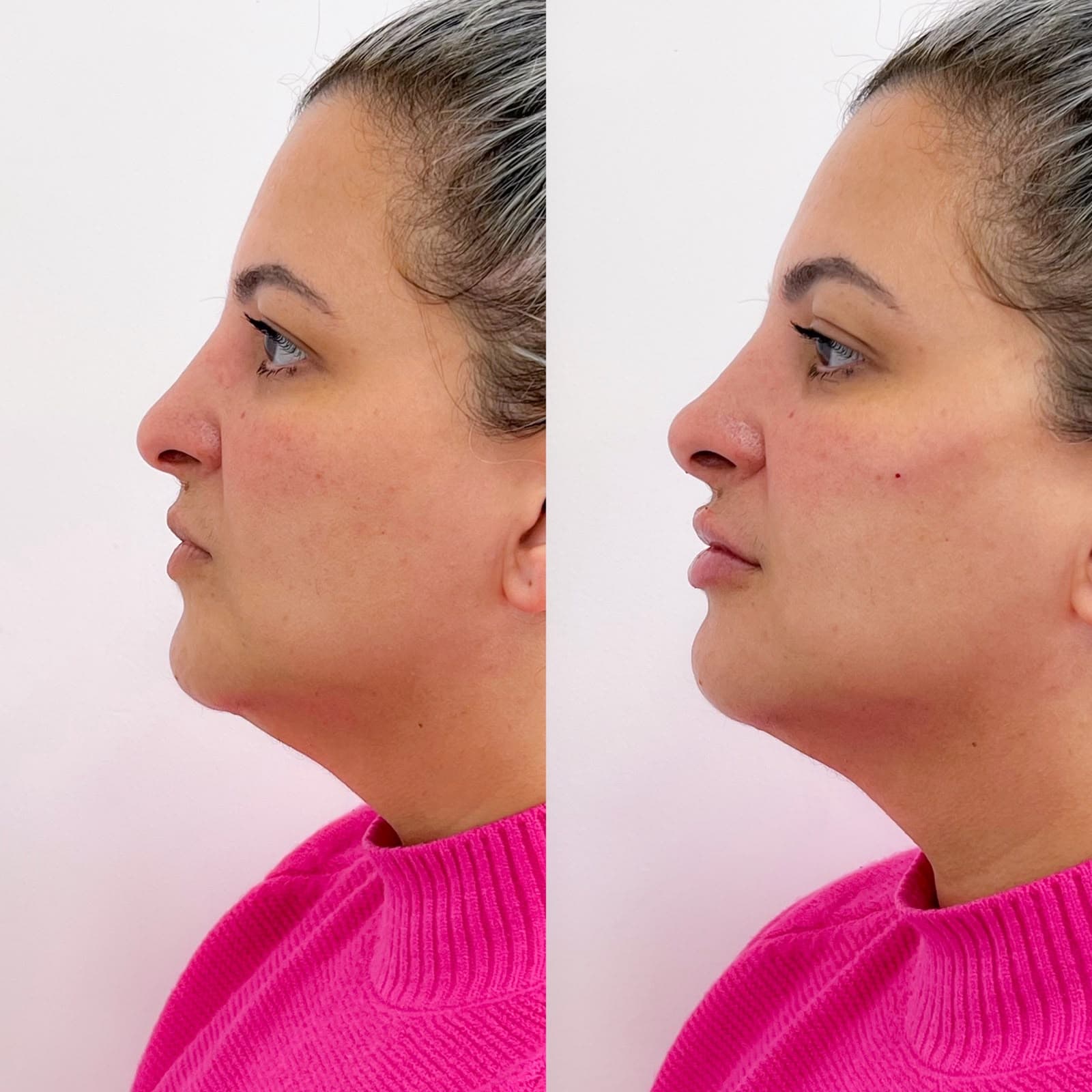 Antes e depois de preenchimento labial e rinomodelação